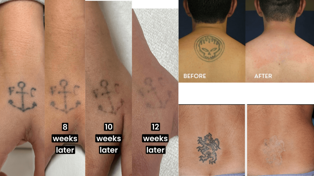 Tattoo removal laser treatment